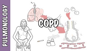 Understanding COPD  Chronic obstructive pulmonary disease cause pathophysiology and treatment [upl. by Pacifa]