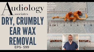 OUR STAFFS FAVOURITE EAR WAX REMOVALS  EP800 [upl. by Zolnay]