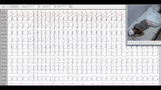 Epilepsy with myoclonic absences 2 of 2 [upl. by Assi941]