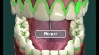 How I Restore Enamel amp Remineralize my Teeth  Reverse Cavities Naturally [upl. by Drofnats905]