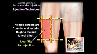 Vastus Lateralis Intramuscular Injection  Everything You Need To Know  Dr Nabil Ebraheim [upl. by Louanne388]