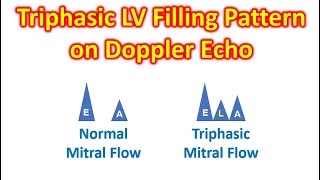 Triphasic LV Filling Pattern on Doppler Echo [upl. by Sleinad447]