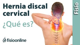 Hernia discal cervical  Qué es y cuáles son sus causas [upl. by Dukie]