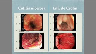 Colitis ulcerosa Vs Enfermedad de Crohn [upl. by Howes604]