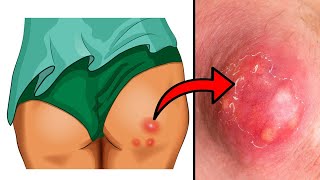 How to Get Rid of Boils on the Bum amp Thighs [upl. by Ailedroc]