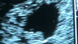 Transvaginal Ultrasound Pregnancy 70 weeks  Ultrasonido transvaginal Embarazo 70 semanas [upl. by Suzan]