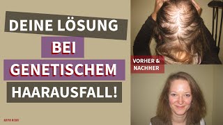 Erfolgreiche Behandlung von genetisch bedingtem Haarausfall mit Kaya Veda Produkten [upl. by Inoy]