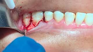 Tratamiento quirúrgico de bolsa Periodontal con Emdogain [upl. by Douglas453]