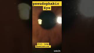 Pseudophakic Eye On Slit Lamp Examination  pseudophakia eyedisease [upl. by Jennifer917]