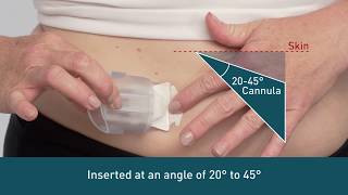 Infusion Sets for Beginners What Are Infusion Sets [upl. by Eceerehs]