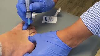 Steroid injection for Morton’s Neuroma [upl. by Jessi]