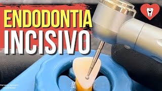 ENDODONTIA SESSÃO ÚNICA INCISIVO SUPERIOR  Endolovers [upl. by Sancha537]