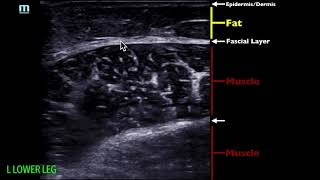 POCUS  Soft Tissue Ultrasound  Soft Tissue Edema [upl. by Aicilla]