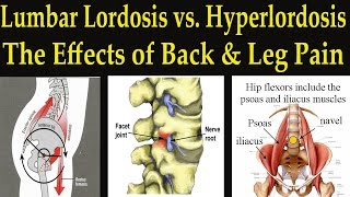 Lumbar Lordosis vs Hyperlordosis  Facet Joint Syndrome Causing Back and Leg Pain  Dr Mandell [upl. by Oleta381]