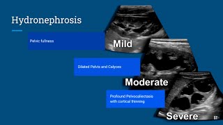 Hydronephrosis Ultrasound [upl. by Adnalohs]