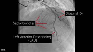 Coronary artery anatomy  Coronary angiogram [upl. by Sarid933]