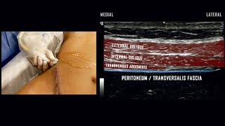 Ultrasound Guided Transversus Abdominis Plane TAP Block [upl. by Repard]