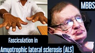 Fasciculation in Amyotrophic lateral sclerosis ALS mbbs medicine neet usmle aiims next [upl. by Jonathan233]