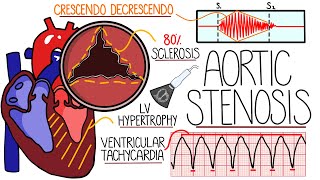 Aortic Stenosis Explained in 10 Minutes With Heart Murmur Sound [upl. by Kerianne317]