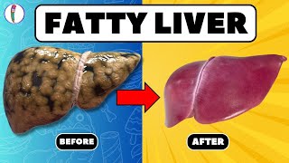 Strictly Avoid these 5 Foods if you have Fatty Liver  Fatty liver treatment  liver disease [upl. by Nalek]