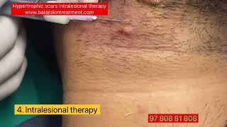 Hypertrophic scar treatment by intralesional therapy Dr Sandeep Gupta BALAJI SKIN CLINIC Hari Nagar [upl. by Liagaba]