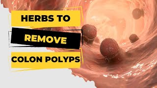 The Ultimate Colon Polyps Remedy Herbs That Work Wonders [upl. by Mano362]