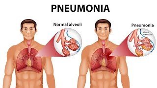 Pneumonia in hindi  Pneumonia के लक्षण  निमोनिया के लक्षण और उपाय Pneumonia in children [upl. by Denni118]