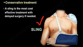 Clavicle Fractures symptoms types diagnosis and treatment with surgery and without surgery [upl. by Suravart]