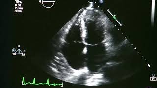 Atrial Fibrillation On Echocardiogram [upl. by Ellahcim]