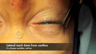 Live Surgery Upper Blepharoplasty Eyelid Lift Part 1 Markings and Anesthesia [upl. by Berl]