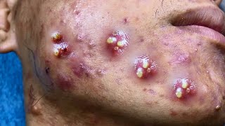 Big Cystic Acne Blackheads Extraction Blackheads amp Milia Whiteheads Removal Pimple Popping [upl. by Sevik]