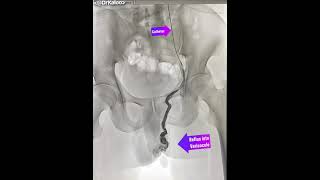 Varicocele Embolisation Angiography venogram of left gonadal vein in a man suffering from [upl. by Tommi]