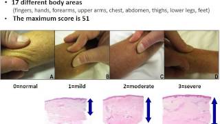 Webinar Diagnosis and Early Management of Scleroderma with Dr Francisco Boin 2015 [upl. by Dannel]