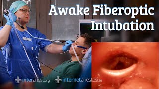 Awake Fiberoptic Intubation [upl. by Trinee]