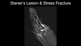 Steners Lesion amp Stress Fracture [upl. by Ivgnout]