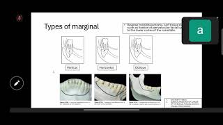 indications of mandibular resection and reconstruction [upl. by Ahterahs]