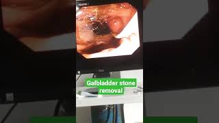 Gallbladder Stones RemovalERCP PROCEDUREdoctor trending viral shorts viralshorts viralvideo [upl. by Anileuqcaj]