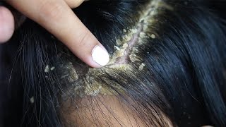 Dandruff scratching removal on head using black combing116 [upl. by Siuqram]