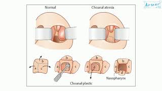 What are choanae  11  BREATHING AND EXCHANGE OF GASES  BIOLOGY  PRADEEP  Doubtnut [upl. by Renae]