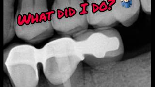 Fractured DENTAL BRIDGE What did I do [upl. by Irelav390]