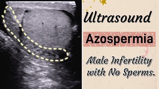 Scrotal Ultrasound  Azoospermia  TypeCauses Male Infertility with No Sperms [upl. by Margarete]