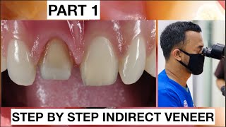 Step by Step 2 Indirect Veneer with Discoloration Tooth Part 1  General Dentist Griya RR [upl. by Dogs274]