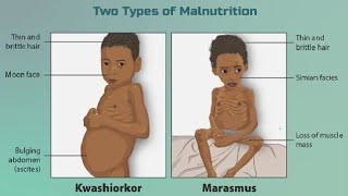 Protein Energy Malnutrition  Kwashiorkor amp Marasmus  Nutritional Disorder  digestion amp absorption [upl. by Odysseus719]