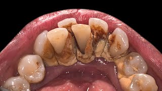 Crowding Teeth Will Increase Tartar Buildup  Scaling [upl. by Beilul]