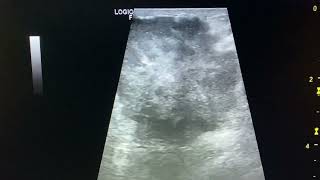 Breast cancer  ultrasound BIRADS 5 [upl. by Llerehs]