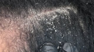 Dandruff Scratching Flakes Removal [upl. by Earvin]