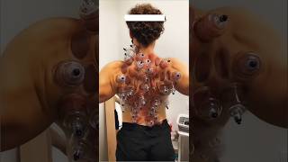 Cupping Therapy Explained 😮shorts amazingfacts experiment [upl. by Ylas]