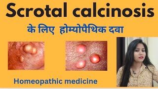 Scrotal calcinosis treatment  Scrotal calcinosis symptomscauses amp homeopathic medicine in hindi [upl. by Eceer]