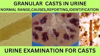 GRANULAR CASTS IN URINECAUSES SYMPTOMS TREATMENT OF GRANULAR CASTS IN URINE EXAMINATION IN HINDI [upl. by Anaeg]