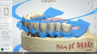 Digital Denture With Ivotion Launched by M S DENTAL ARTS DENTAL LAB [upl. by Wamsley]